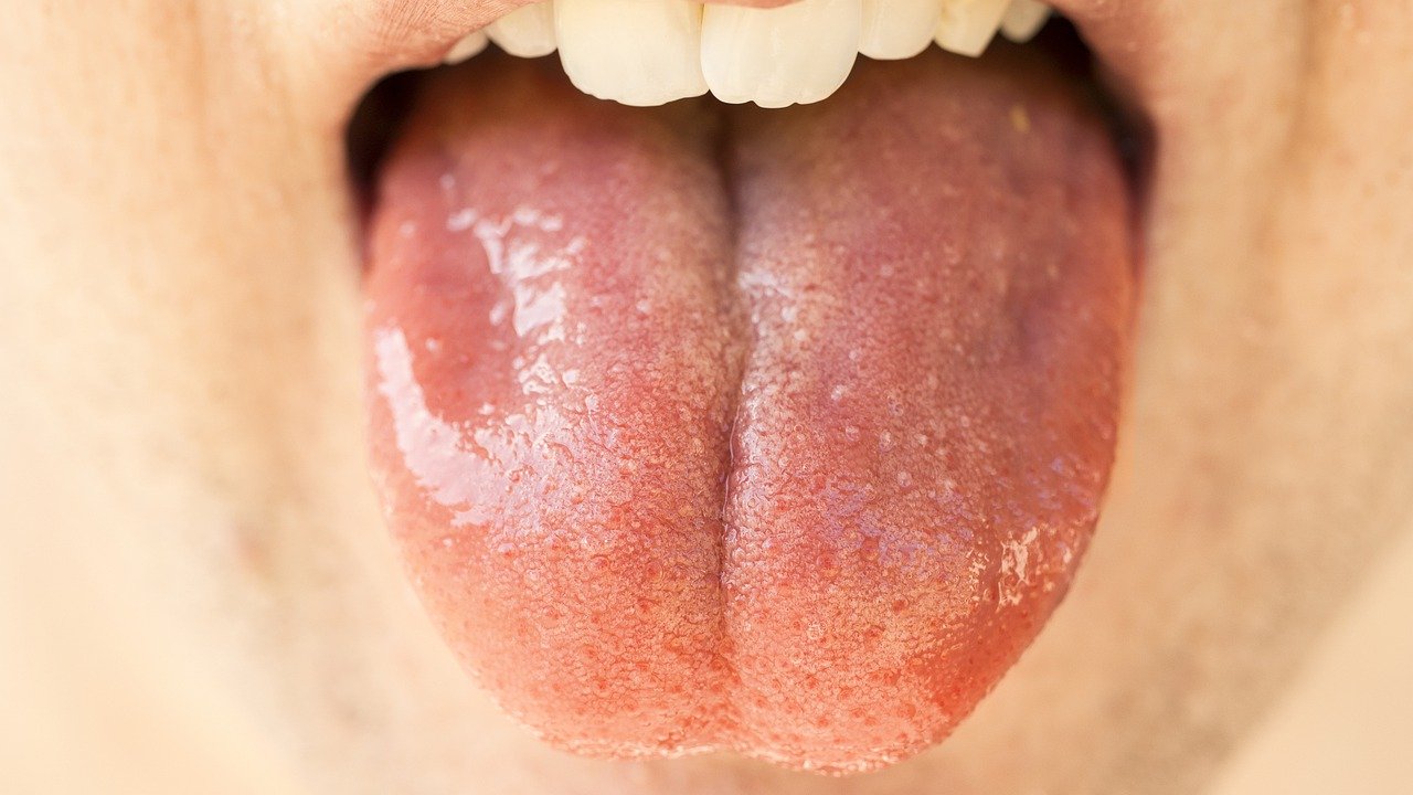 Can Dry Mouth Cause Cavities